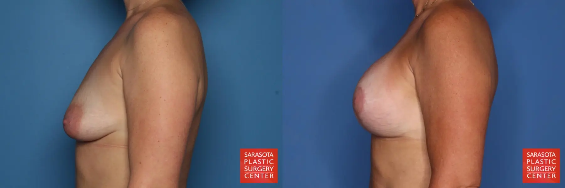 Breast Augmentation With Mesh : Patient 1 - Before and After 3