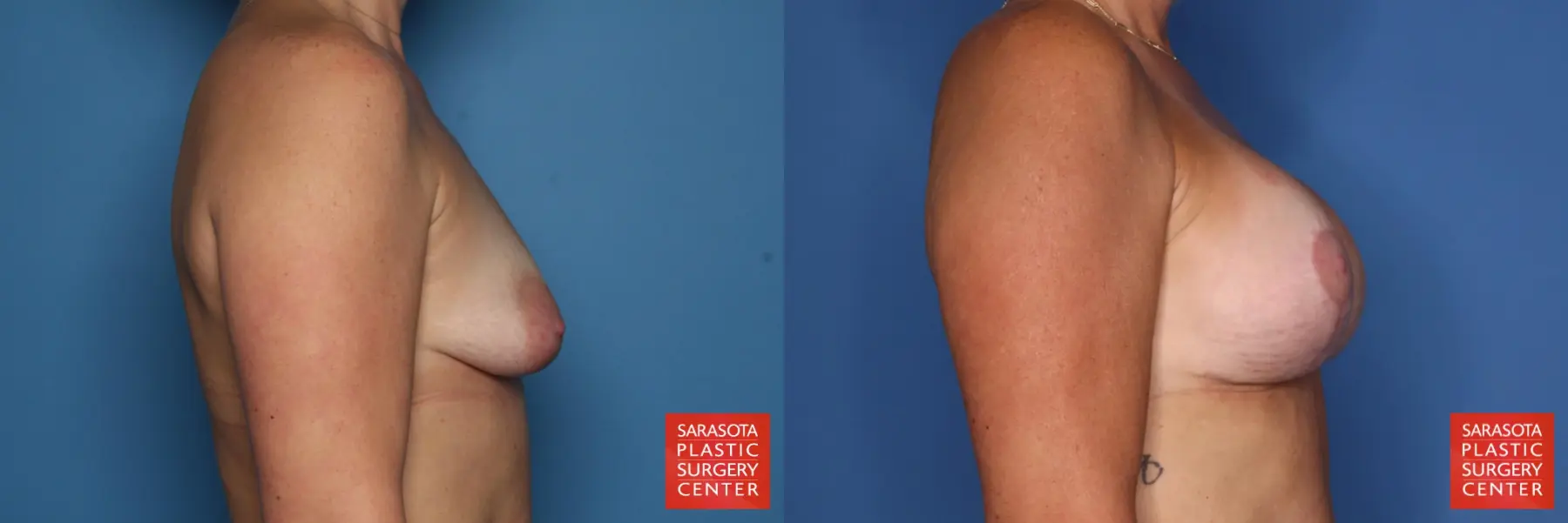 Breast Augmentation With Mesh : Patient 1 - Before and After 5