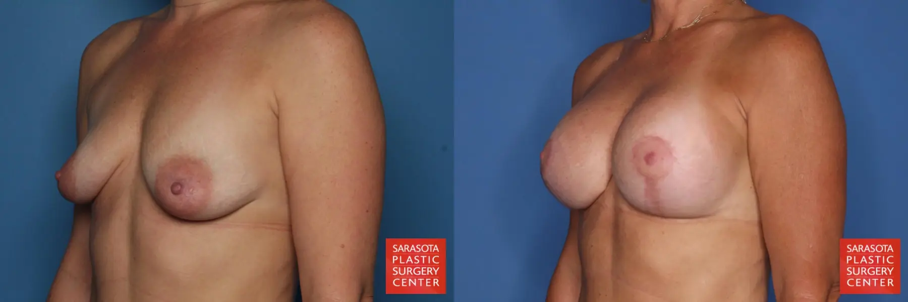 Breast Augmentation With Mesh : Patient 1 - Before and After 2