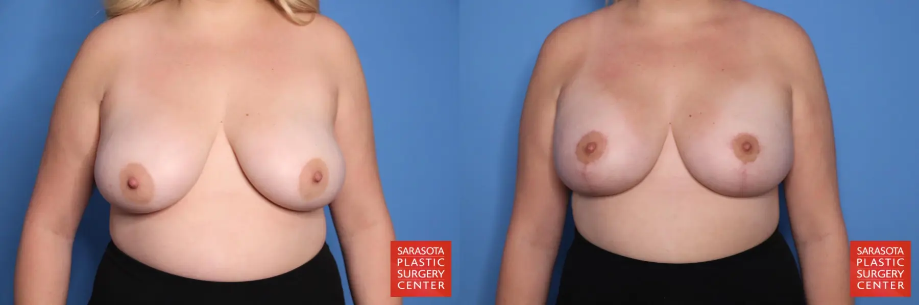 Breast Augmentation With Reduction: Patient 1 - Before and After  