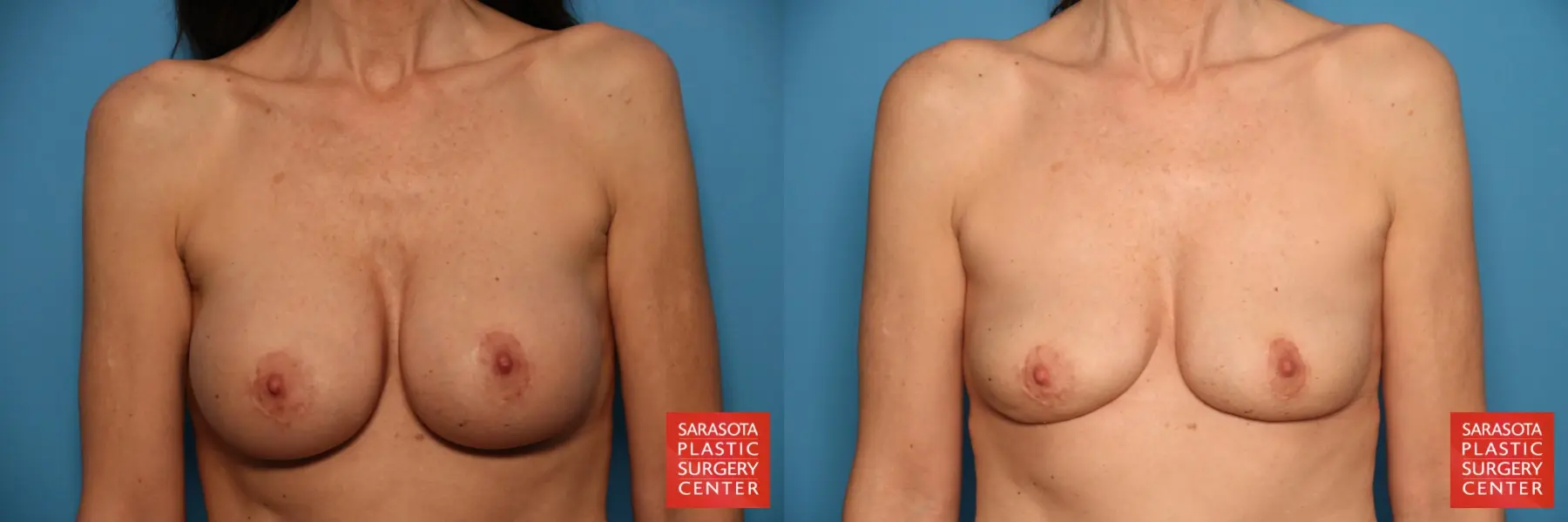 Breast Implant Removal: Patient 2 - Before and After  
