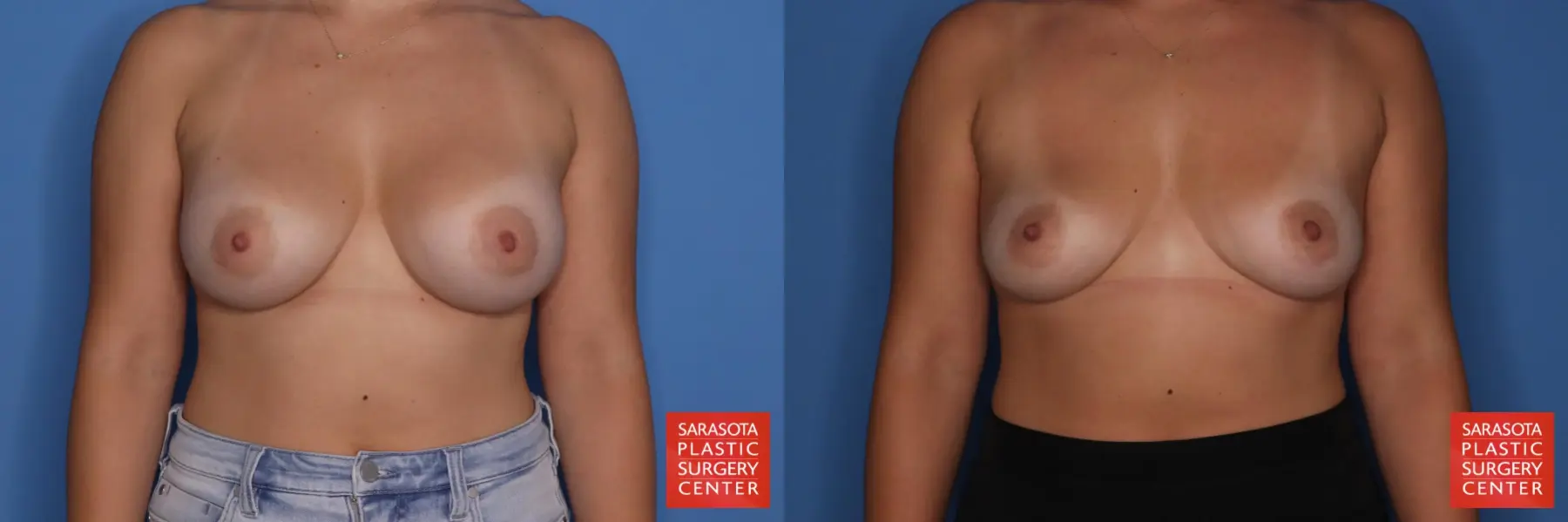 Breast Implant Removal: Patient 1 - Before and After  