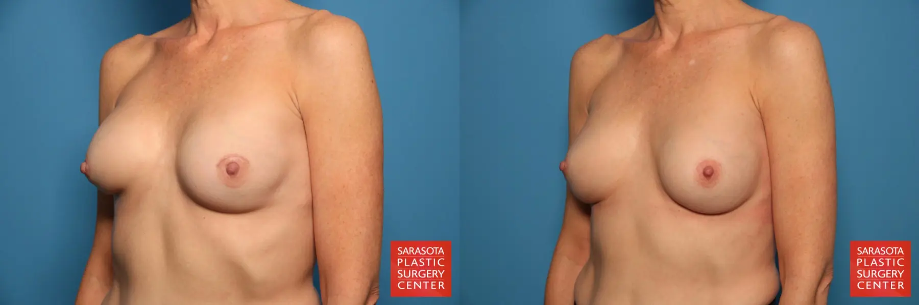 Breast Implant Removal/Replacement: Patient 8 - Before and After 2