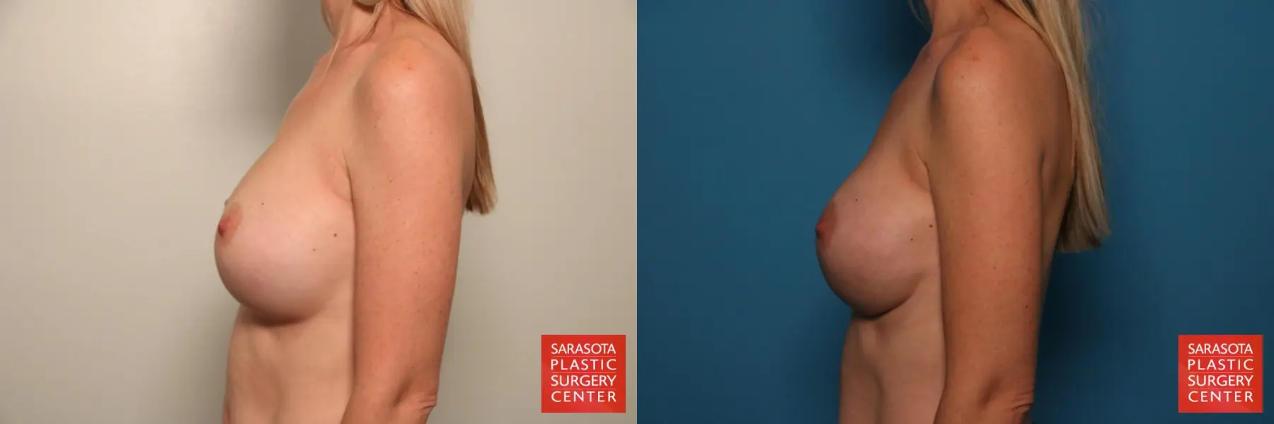Breast Implant Removal/Replacement: Patient 10 - Before and After 3