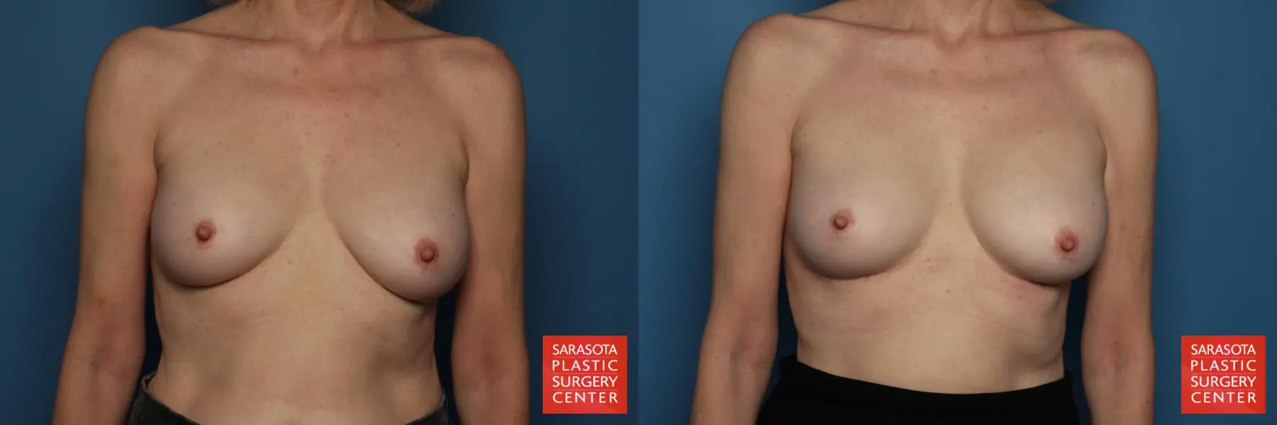 Breast Implant Removal/Replacement: Patient 11 - Before and After  