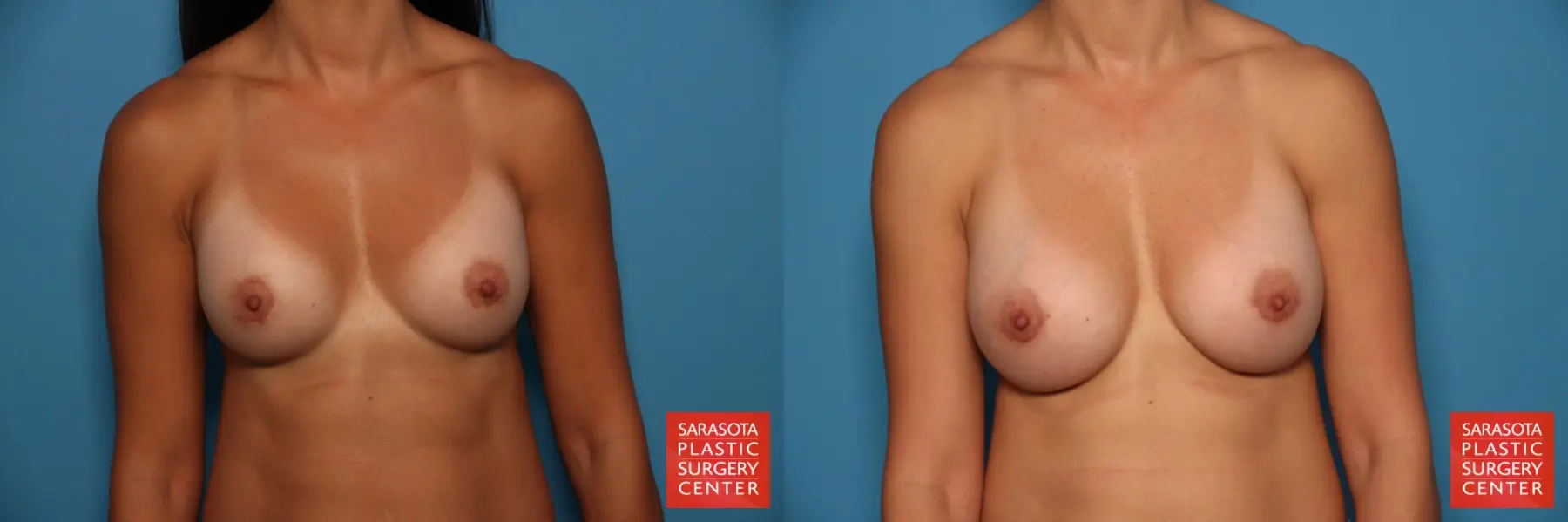 Breast Implant Removal/Replacement: Patient 9 - Before and After  
