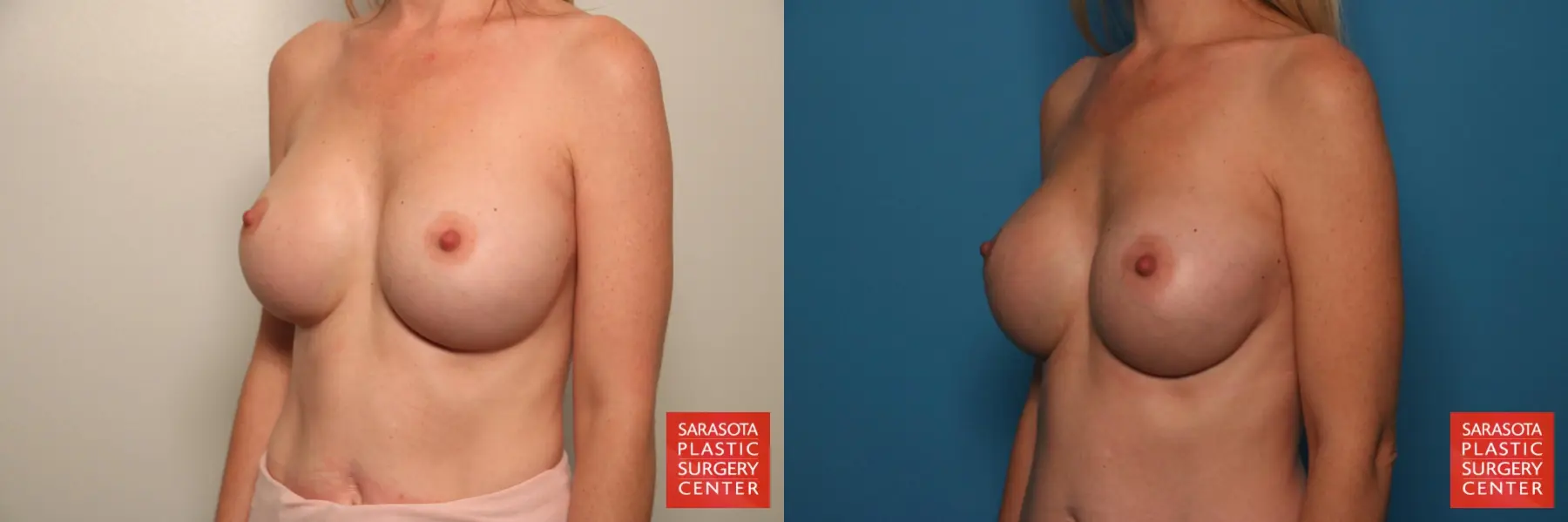 Breast Implant Removal/Replacement: Patient 10 - Before and After 2