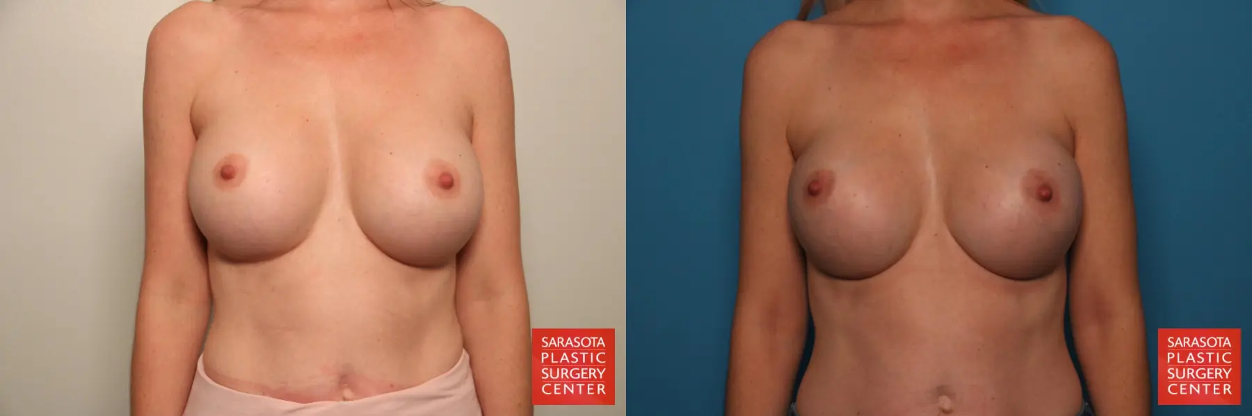 Breast Implant Removal/Replacement: Patient 10 - Before and After  