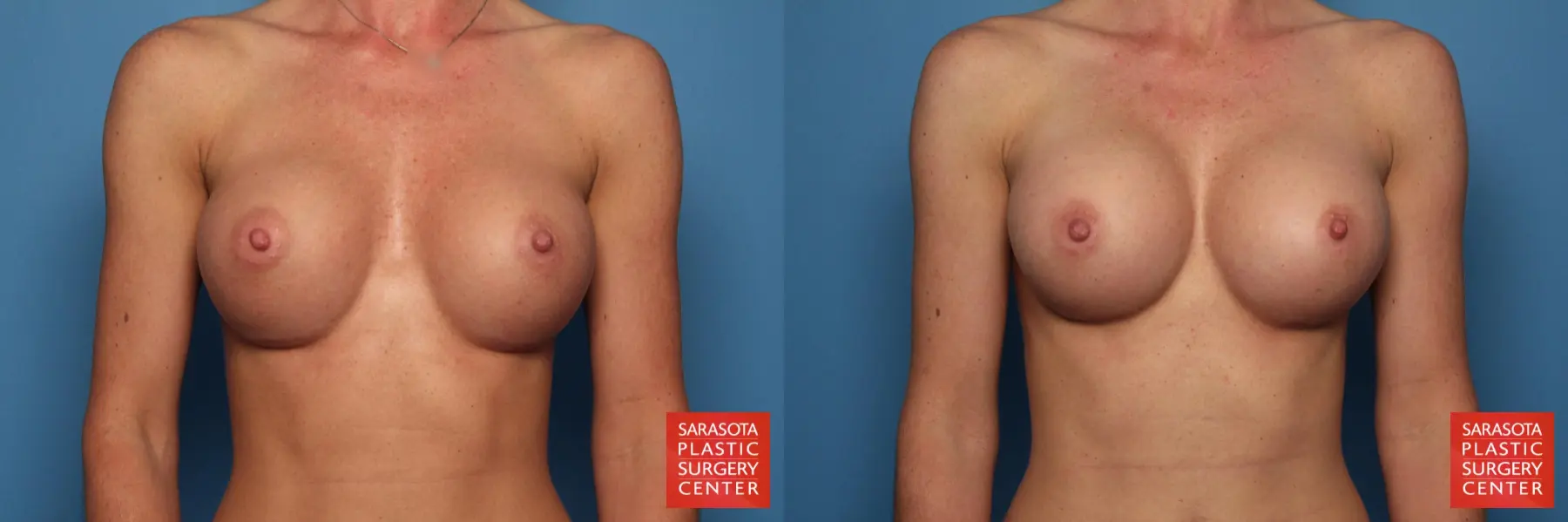 Breast Implant Removal/Replacement: Patient 4 - Before and After  