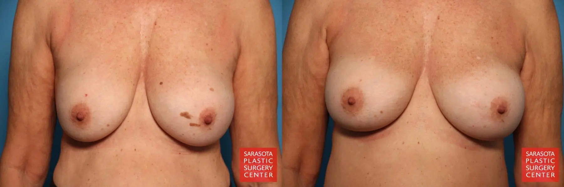 Breast Implant Removal/Replacement: Patient 12 - Before and After  