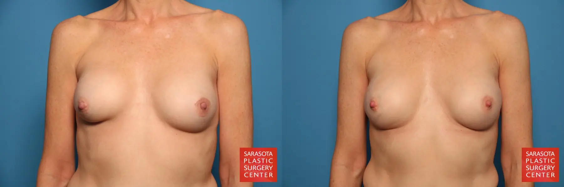 Breast Implant Removal/Replacement: Patient 8 - Before and After  