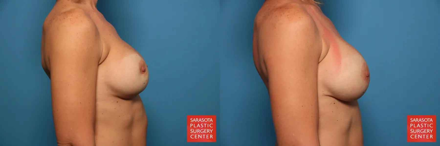 Breast Implant Removal/Replacement: Patient 2 - Before and After 3