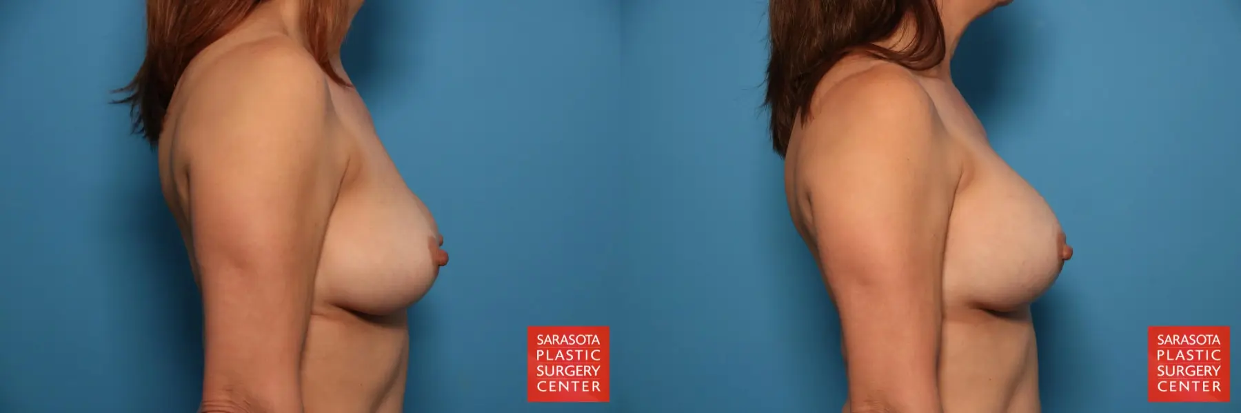 Breast Implant Removal/Replacement: Patient 7 - Before and After 5