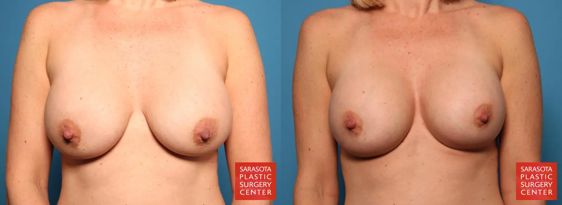 Breast Implant Removal/Replacement: Patient 1 - Before and After  
