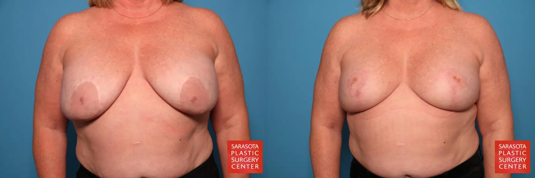 Breast Implant Removal/Replacement W/Lift And Tissue Removal: Patient 1 - Before and After  