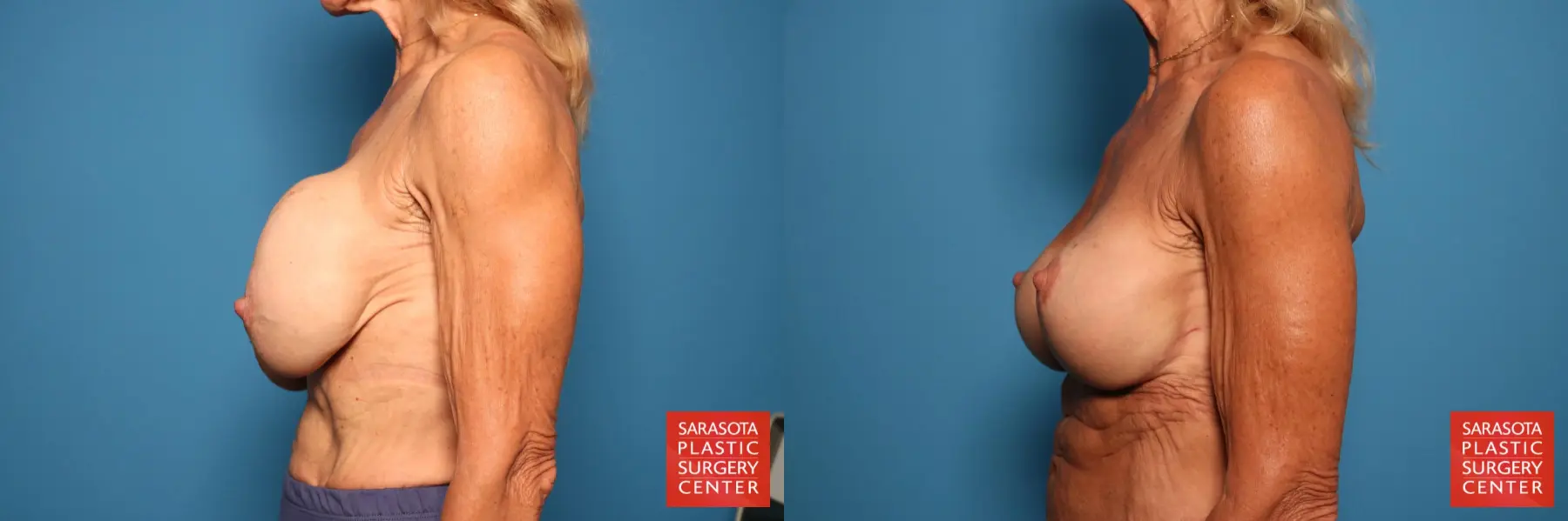 Breast Implant Removal/Replacement W/Lift: Patient 7 - Before and After 3