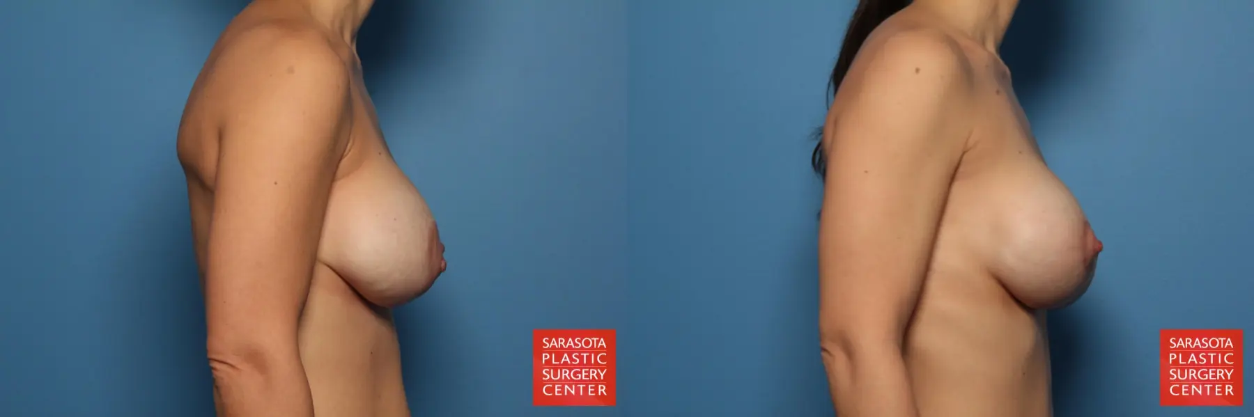 Breast Implant Removal/Replacement W/Lift: Patient 5 - Before and After 3