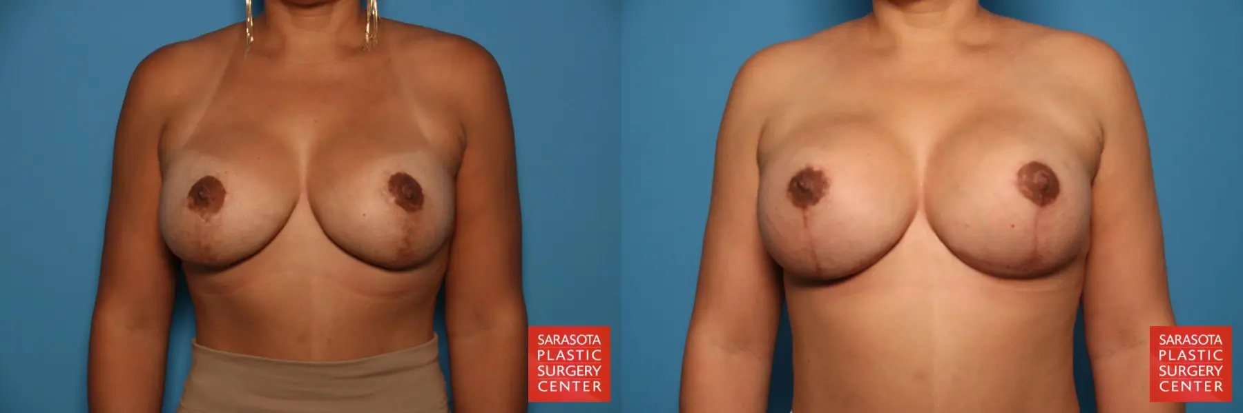 Breast Implant Removal/Replacement W/Lift: Patient 3 - Before and After  