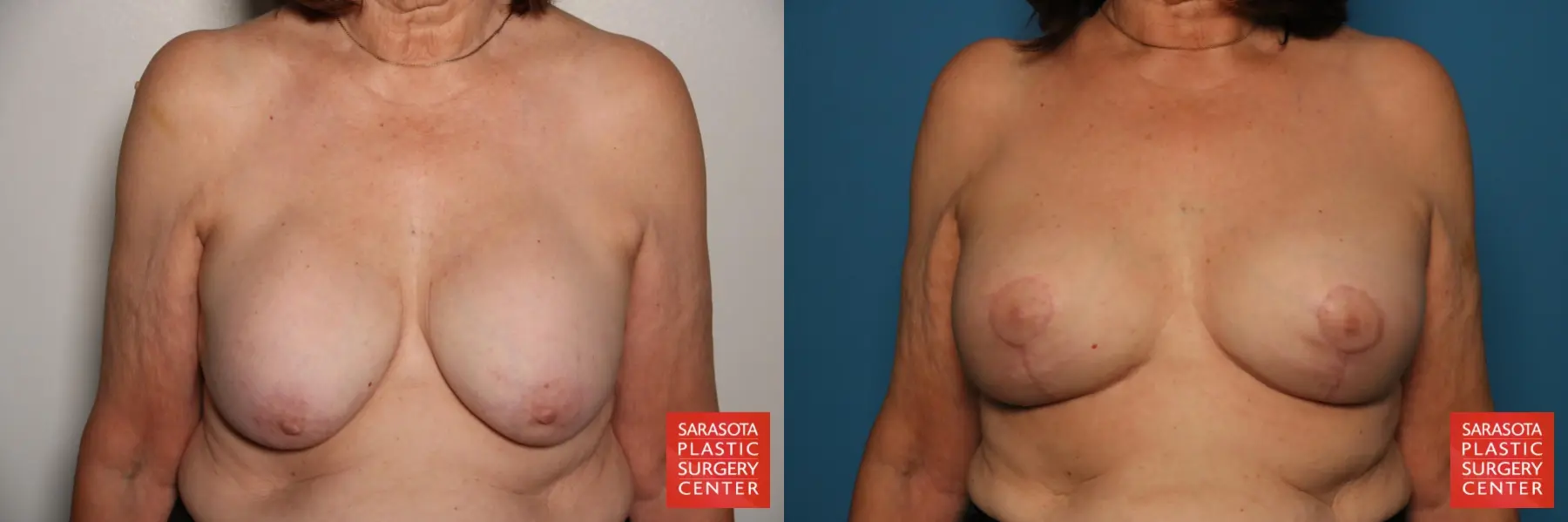 Breast Implant Removal/Replacement W/Lift: Patient 6 - Before and After  