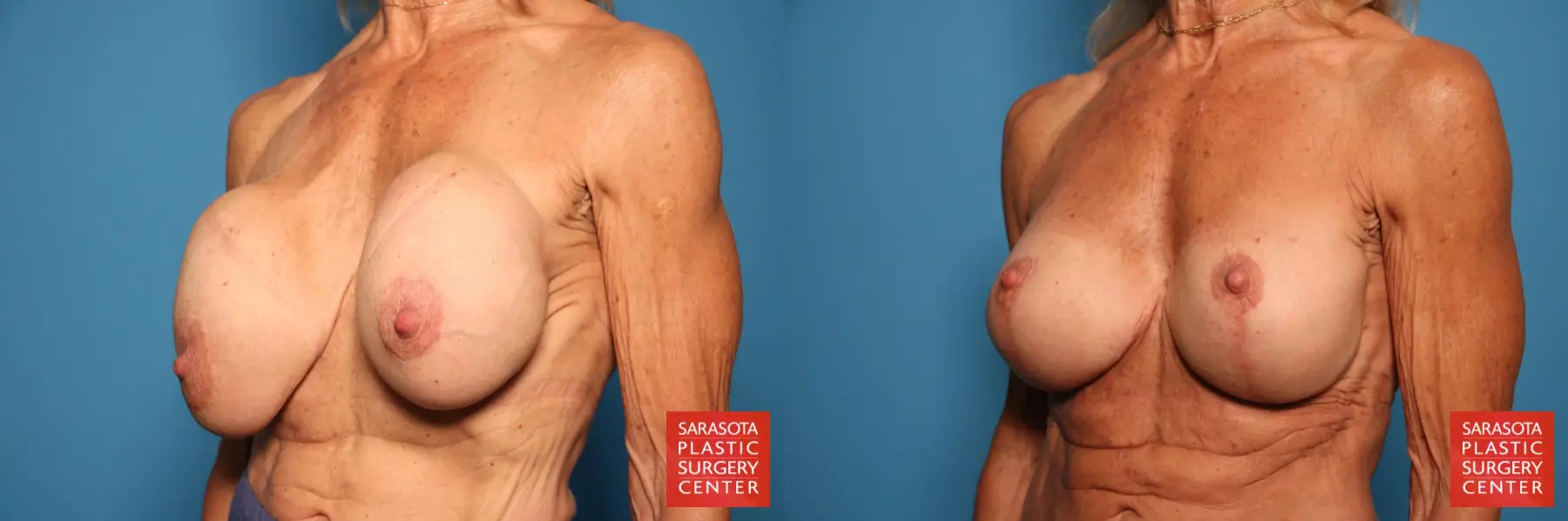 Breast Implant Removal/Replacement W/Lift: Patient 7 - Before and After 2