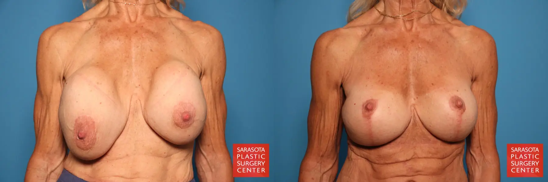 Breast Implant Removal/Replacement W/Lift: Patient 7 - Before and After  