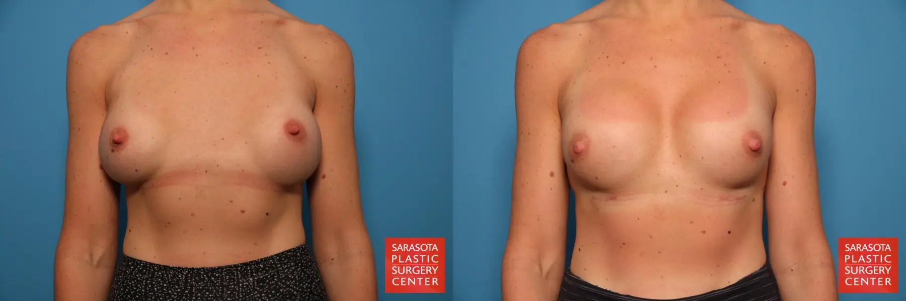 Breast Implant Removal/Replacement W/Mesh: Patient 1 - Before and After  