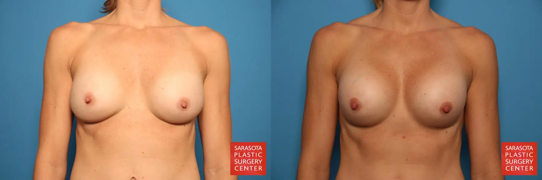 Breast Implant Removal/Replacement W/Mesh: Patient 2 - Before and After  