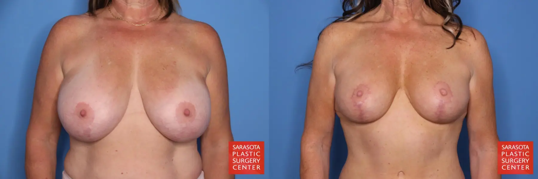 Breast Implant Removal/Replacement W/smaller Implant & Lift: Patient 6 - Before and After  