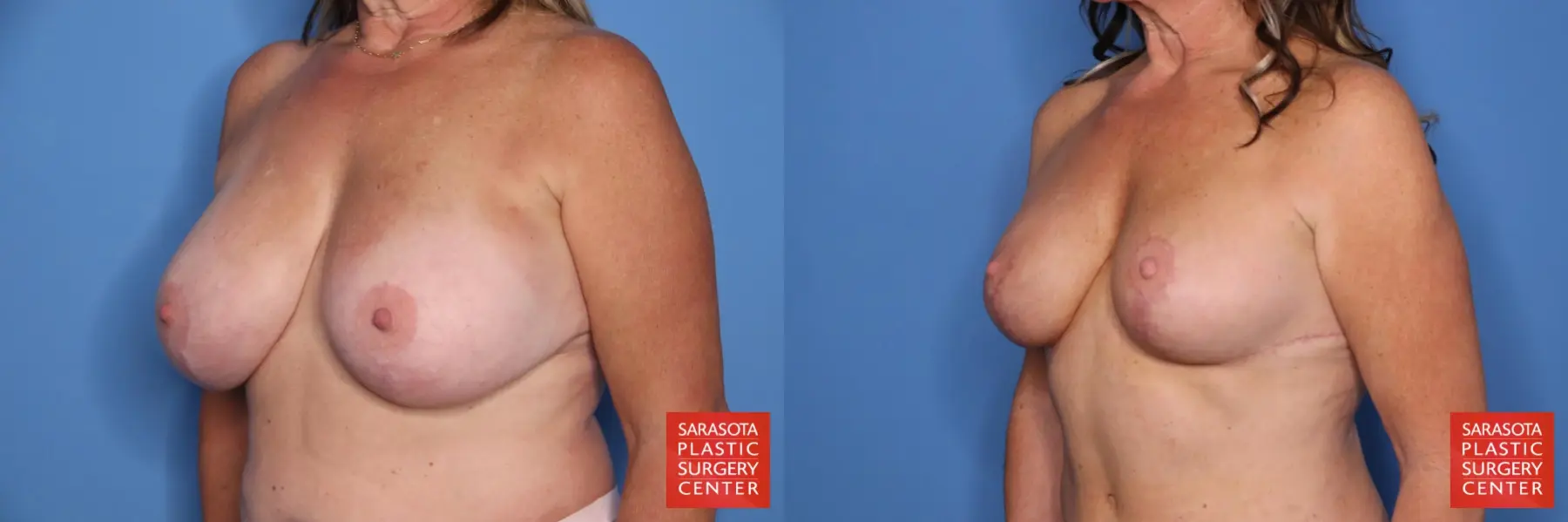 Breast Implant Removal/Replacement W/smaller Implant & Lift: Patient 6 - Before and After 2