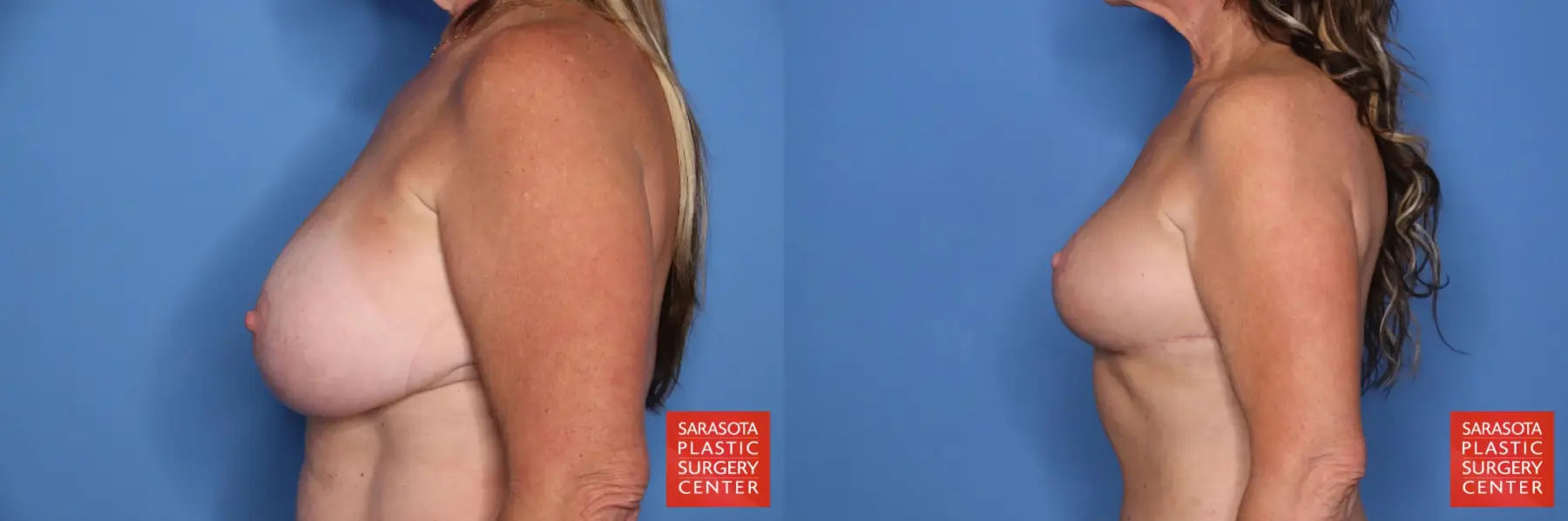 Breast Implant Removal/Replacement W/smaller Implant & Lift: Patient 6 - Before and After 3