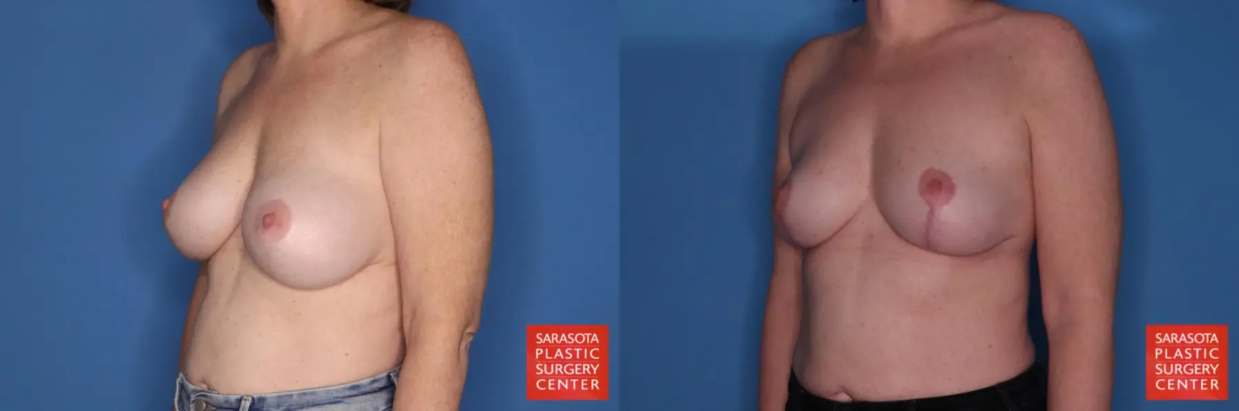 Breast Implant Removal With Lift: Patient 6 - Before and After 4
