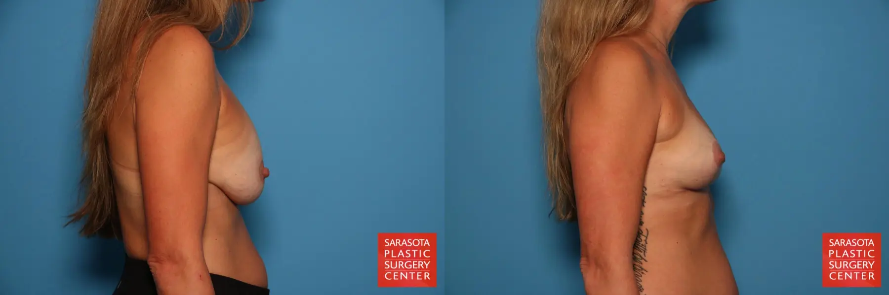 Breast Implant Removal With Lift: Patient 1 - Before and After 5