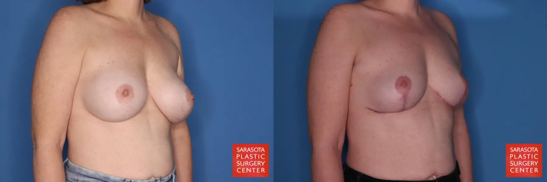 Breast Implant Removal With Lift: Patient 6 - Before and After 2