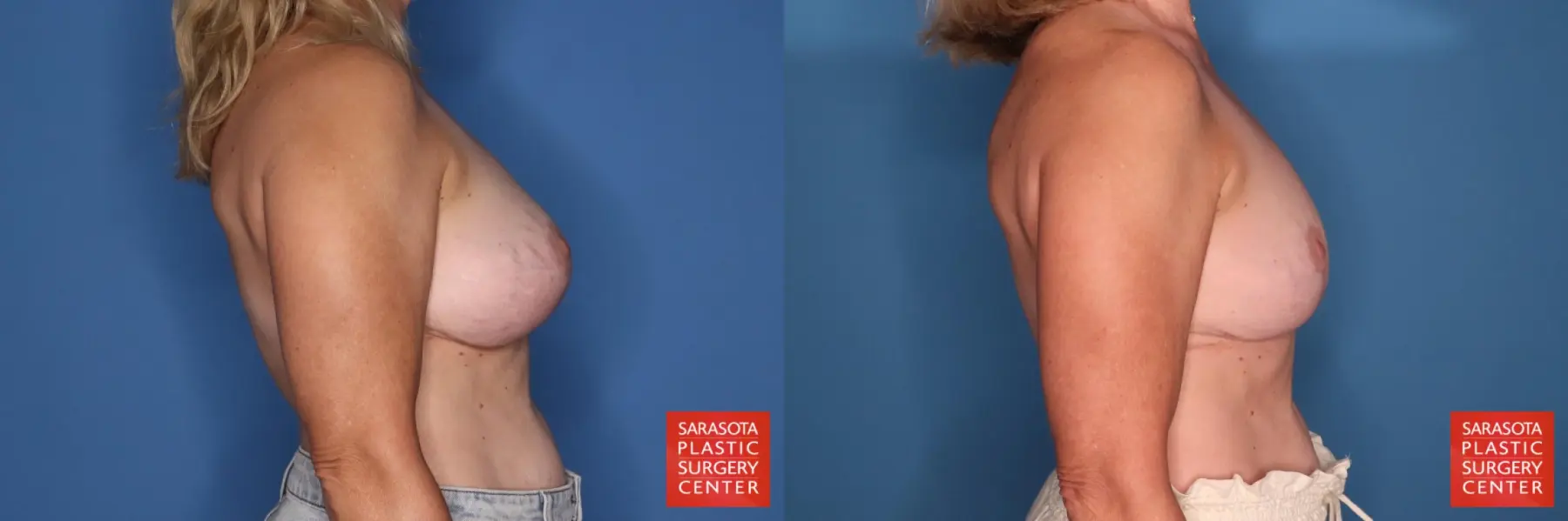 Breast Implant Removal With Lift: Patient 8 - Before and After 5