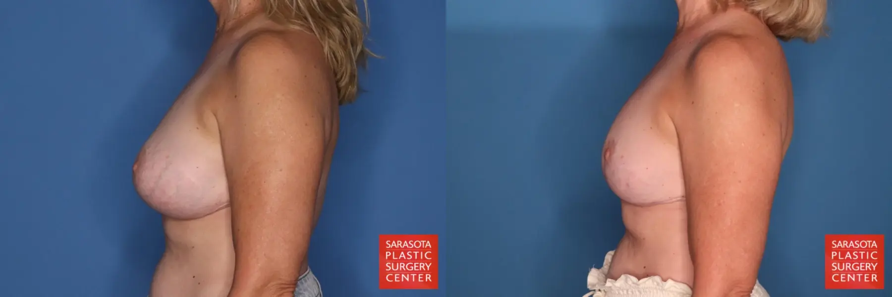Breast Implant Removal With Lift: Patient 8 - Before and After 3