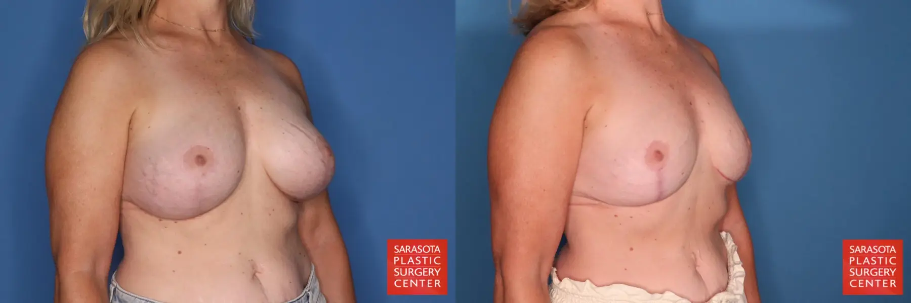 Breast Implant Removal With Lift: Patient 8 - Before and After 4
