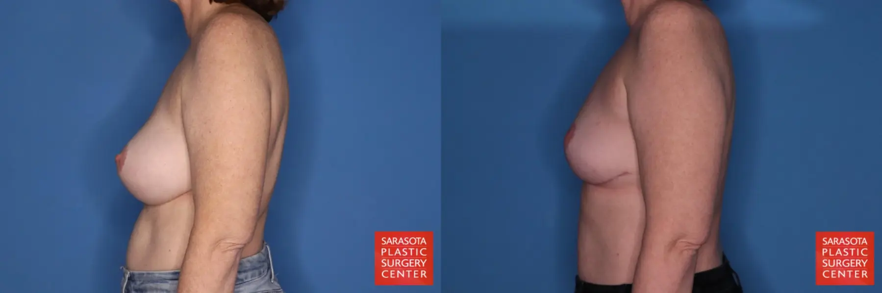 Breast Implant Removal With Lift: Patient 6 - Before and After 5