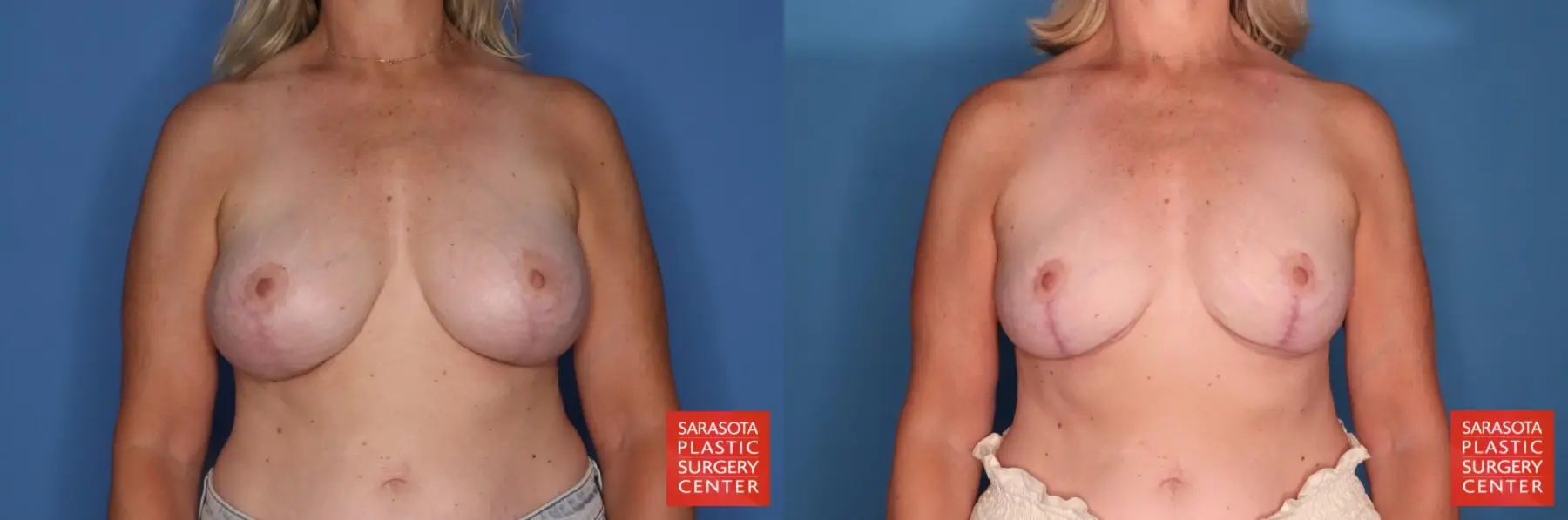 Breast Implant Removal With Lift: Patient 8 - Before and After