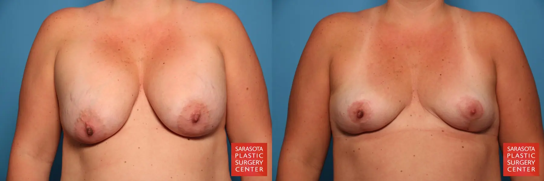 Breast Implant Removal With Lift: Patient 2 - Before and After  