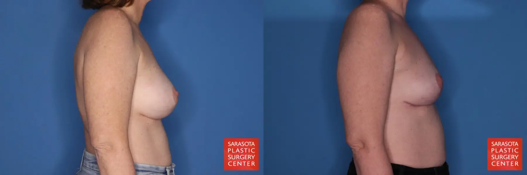 Breast Implant Removal With Lift: Patient 6 - Before and After 3