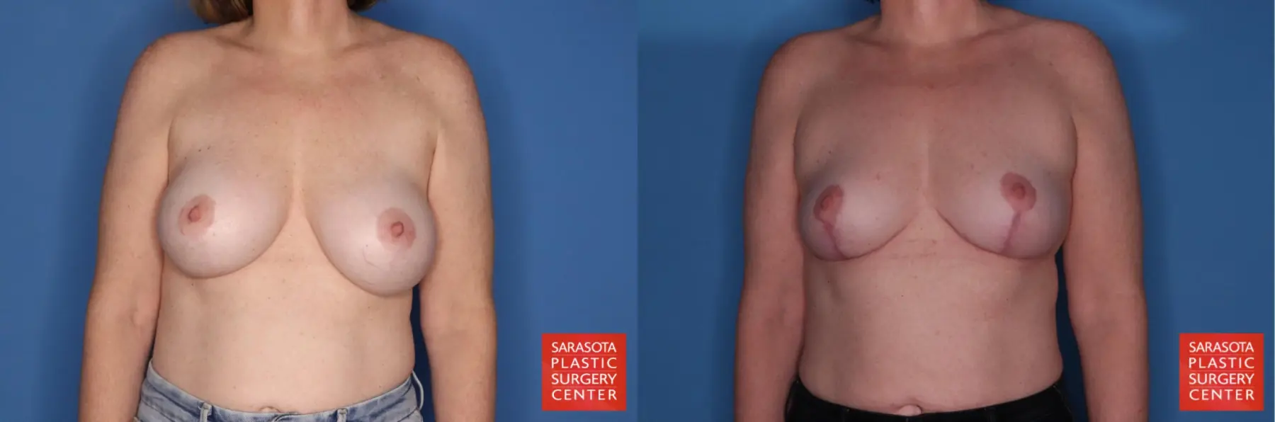 Breast Implant Removal With Lift: Patient 6 - Before and After