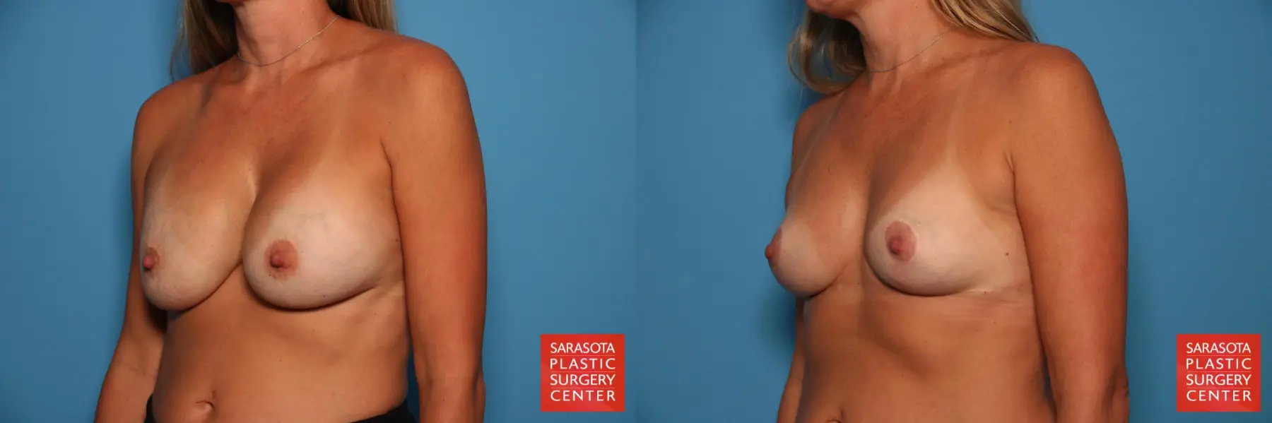 Breast Implant Removal With Lift: Patient 1 - Before and After 2