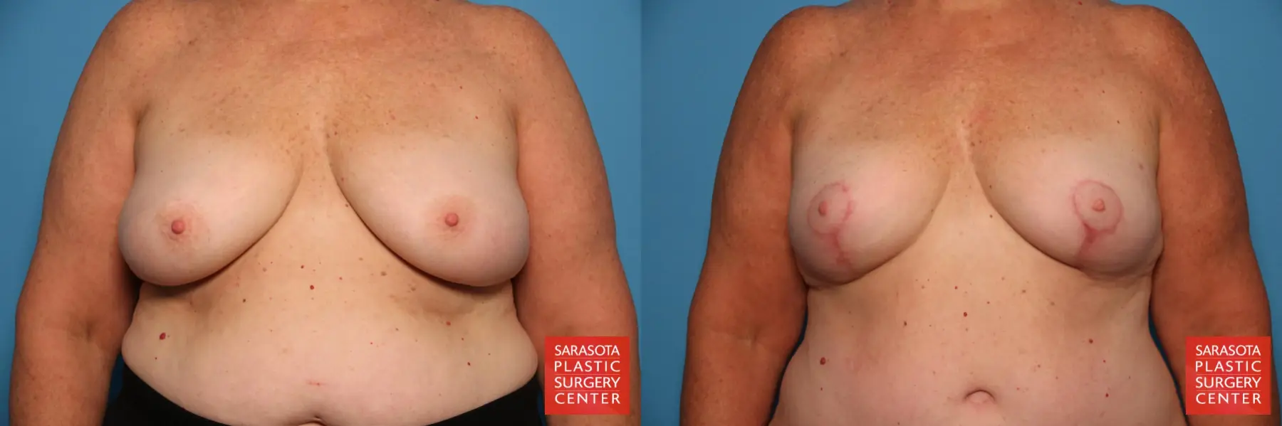 Breast Lift - Fat: Patient 1 - Before and After  