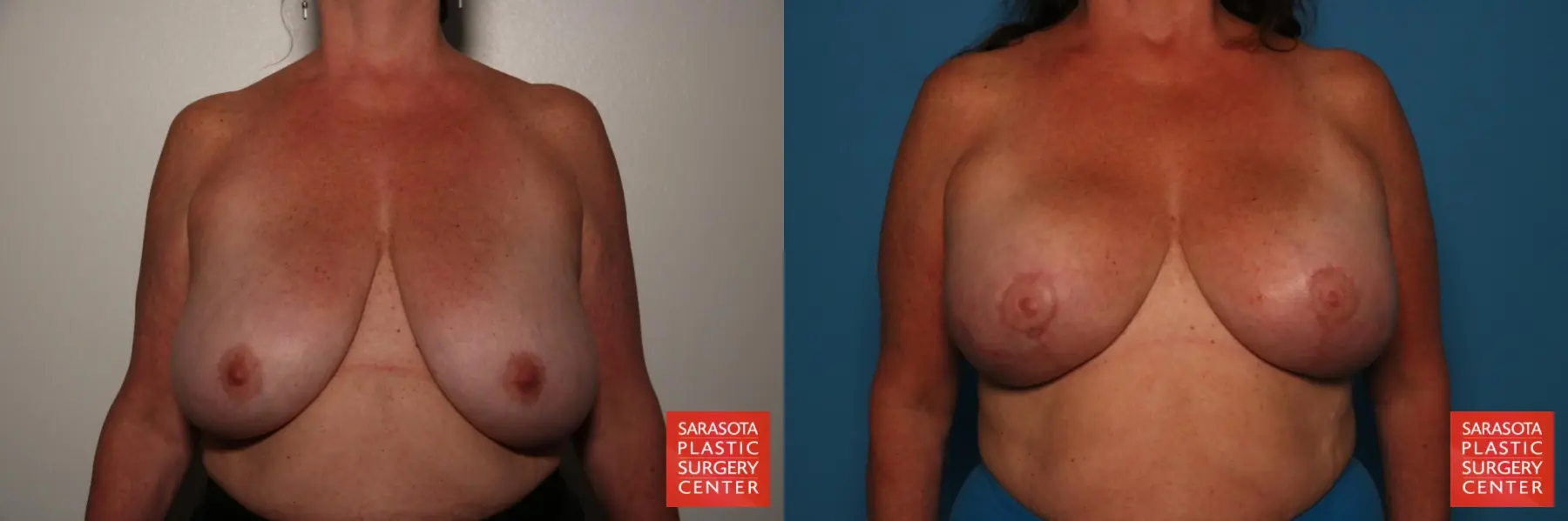 Breast Lift: Patient 4 - Before and After  