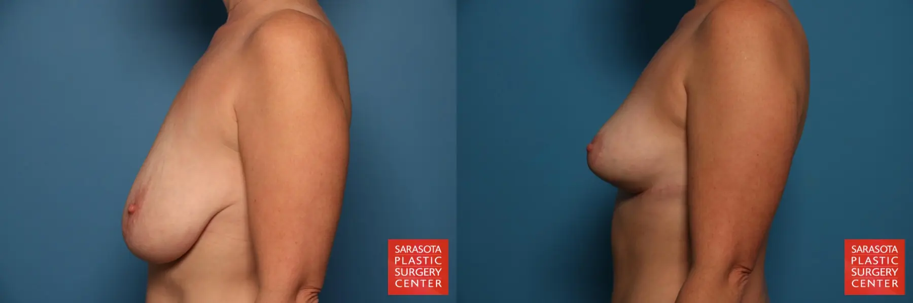Breast Lift: Patient 2 - Before and After 3