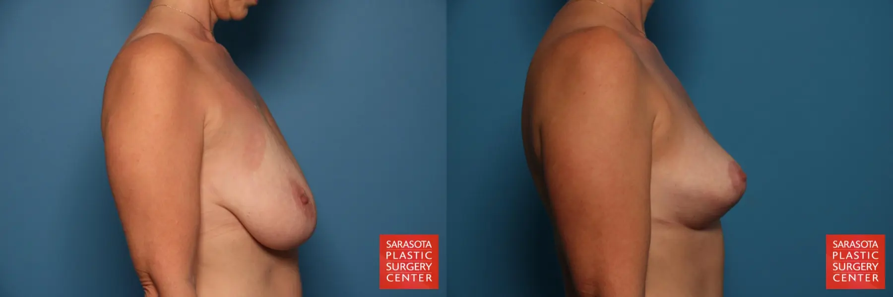 Breast Lift: Patient 2 - Before and After 5