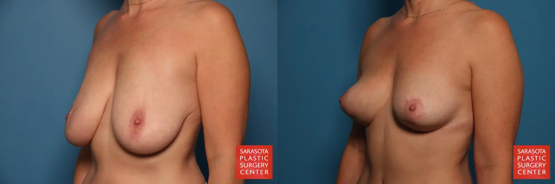 Breast Lift: Patient 2 - Before and After 2