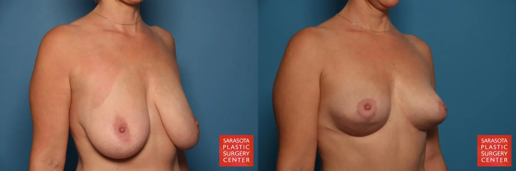 Breast Lift: Patient 2 - Before and After 4