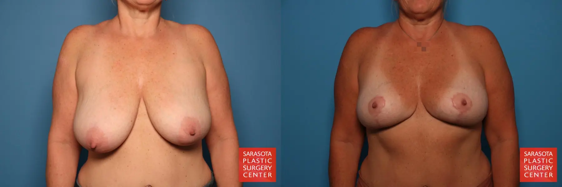 Breast Lift: Patient 3 - Before and After  