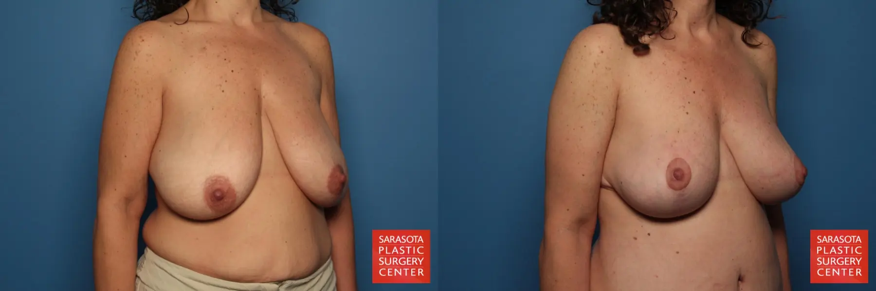 Breast Lift: Patient 5 - Before and After 4